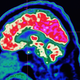 A picture of a human brain taken by a positron emission tomography scanner.